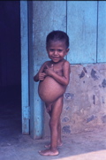 Nicaragua 1982-83 Waslala malnutrito