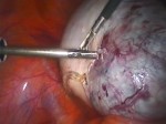 asportazione di cisti ovarica luteinica in laparoscopia 