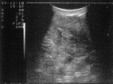 L'ecografia pelvica transvaginale  uno strumento sia diagnostico (individuazione di patologie su pazienti sintomatiche) sia di screening (controllo periodico su pazienti sintomatiche). L'ecopelvica T.V. studia l'ecopattern endometriale, le pareti uterine, le ovaie la pelvi in senso lato
