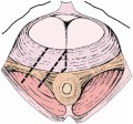L' episiotomia meglio colpoperineotomia  il taglio della mucosa vaginale, del piano muscolare e del perineo.