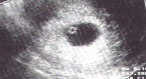 gravidanza extrauterina, geu, ginecologia, ecografia gravidanza extrauterina,  laparoscopia gravidanza extrauterina, Beta-HCG, laparotomia