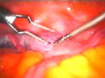 isterectomia totale con annessiectomia bilaterale per via laparoscopica