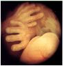 Tecnica endoscopica ambulatoriale che consente la visione diretta della cavit uterina. Al pari dell'ecopelvica T.V. e della laparoscopia rappresenta una vera rivoluzione, in ginecologia, in termini di efficacia sicurezza trasparenza. Si ricorre all'isteroscopia in tre situazioni, sanguinamento anomalo, ecopattern endometriale ispessito od irregolare, fattore uterino nella paziente infertile